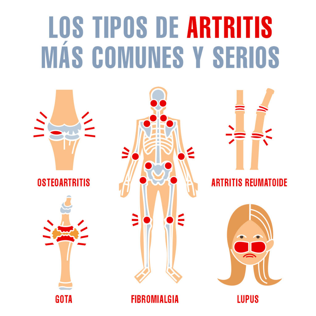 prevencion de artritis