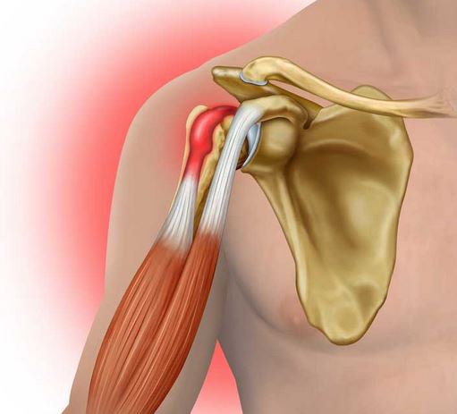 Desgarro del tendón del bíceps en el hombro