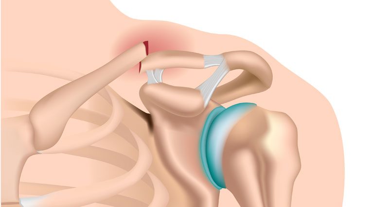 Fractura de clavícula – Clavícula rota