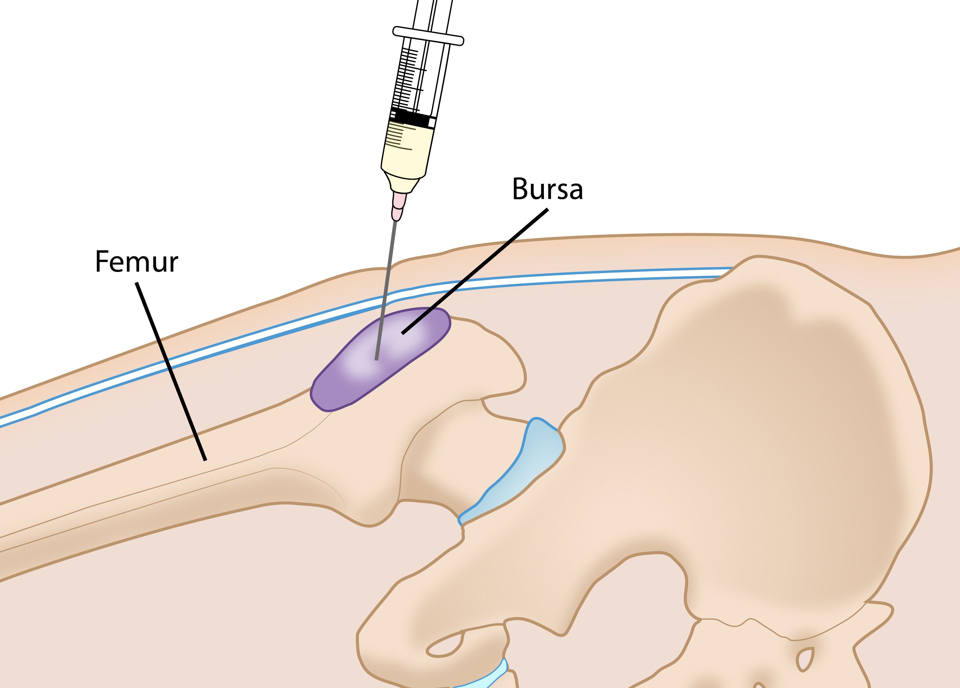 Bursitis de cadera