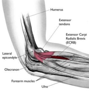 Epicondilitis – Codo de tenista