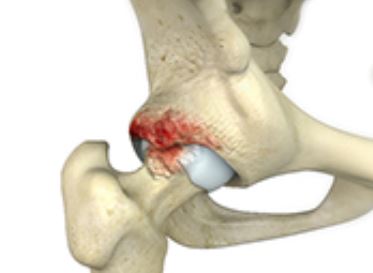 Femoroacetabular Impingement (FAI)