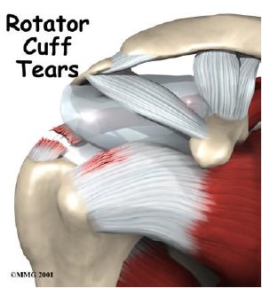 Rotator Cuff Repair