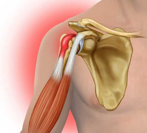 Biceps Tendon Tear at the Shoulder