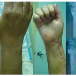 Hand fractures Miami