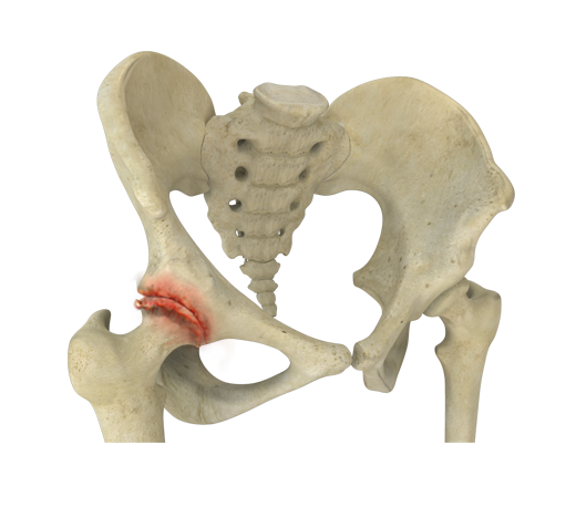 Hip Arthritis