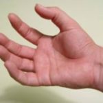 Thumb/Metacarpal Sprains