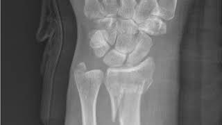 Wrist Fractures