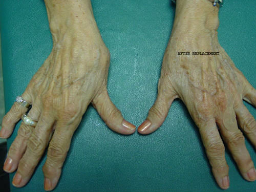 Basal Joint Arthritis of the Thumb