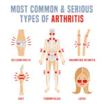 Most common types of arthritis