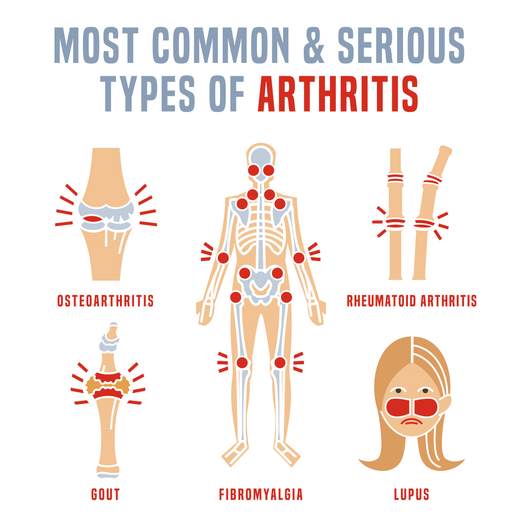 Arthritis Types