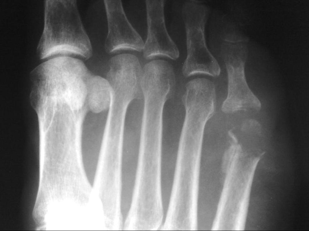 Osteomyelitis