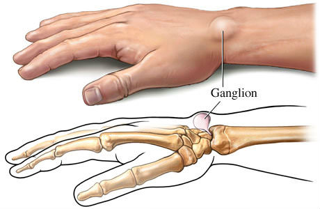 What is a Ganglion Cyst?