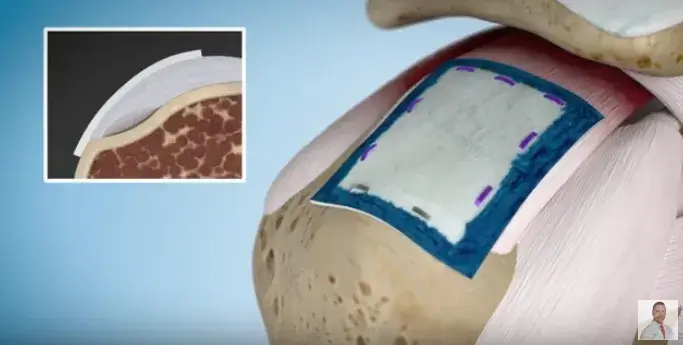 Rotator Cuff Problem? Put a Patch on it – Literally