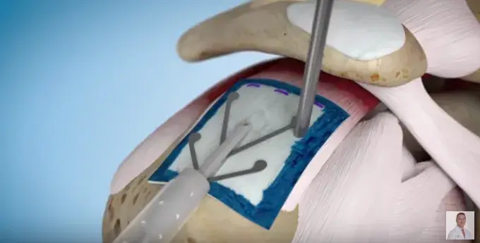 Patient Testimonial: Bioinductive Implant For Rotator Cuff Repair