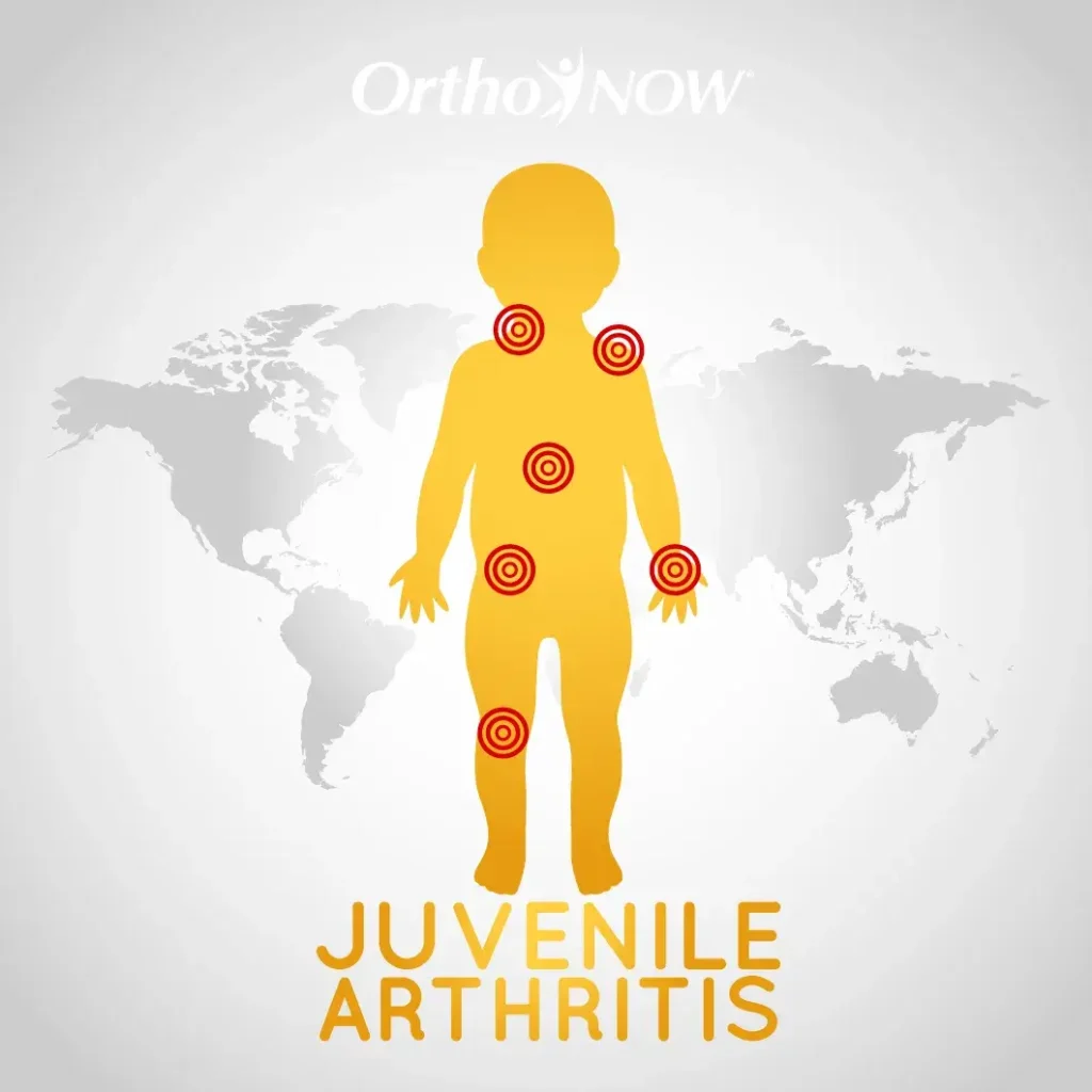 Children Can Get Arthritis Too